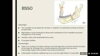 orthognathic surgery 2 [upl. by Kalikow]