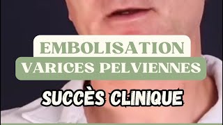 EMBOLISATION VARICES PELVIENNES ➡️ succès clinique [upl. by Delora]