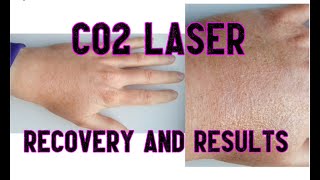 CO2 laser on handsRecovery and before and after [upl. by Noble]