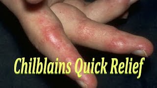 CHILBLAINS QUICK RELIEF  EASY HOME REMEDY FOR CHILBLAINS  CURE FOR बिवाई PERNIOSIS [upl. by Rez737]