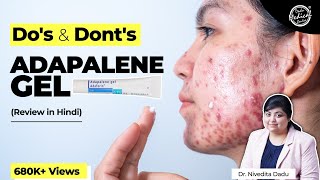 How I got rid of my acne after 12 years  Differin gel review [upl. by Octavla]