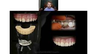 BASICS OF INJECTABLE TECHNIQUE in anterior and posterior dentition  Free Webinar [upl. by Amerak661]