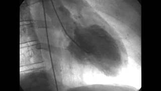 Procedural Coronary Angiography of Coronary Artery Thrombus Aspiration Followed by Bolus Intracorona [upl. by Siron665]