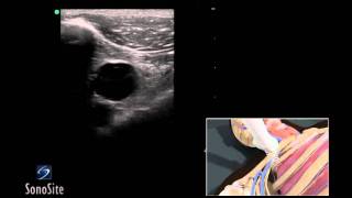 How To Ultrasound Guided Insertion of a Subclavian Vein Catheter 3D Video [upl. by Aierbma]