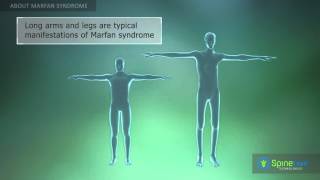 Marfan Syndrome About [upl. by Ailedua874]