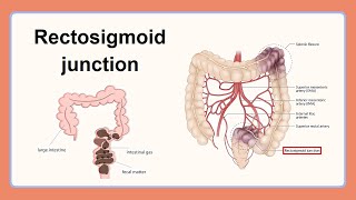 rectosigmoid junction [upl. by Herrod623]