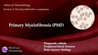 Primary Myelofibrosis PMF [upl. by Pietra]