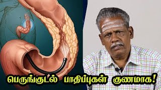 பெருங்குடல் பாதிப்புகள் குணமாக  What Is Colitis Symptoms Causes amp Treatment in Tamil [upl. by Sylado]