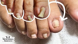 Incredible Pincer Toenail Makeover A Transformation [upl. by Llerrahs]