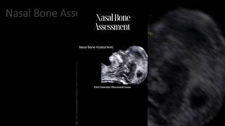 How to Accurately Assess The Fetal Nasal Bone [upl. by Schott]