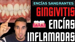 GINGIVITIS TRATAMIENTO y SÍNTOMAS  ENCIAS INFLAMADAS [upl. by Atthia108]