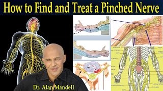 How To Find and Treat a Pinched Nerve Simple Neurology  Dr Mandell [upl. by Asile]