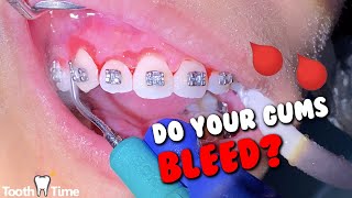 braces gum swellingbleeding  Why and what to do  Tooth Time Family Dentistry New Braunfels [upl. by Walczak]