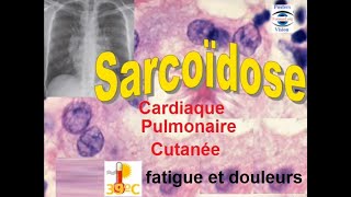 Sarcoidose pulmonaire articulaire renale hepatique cutanée ophtalmologique [upl. by Ykcub755]