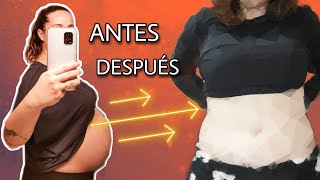 💥​EMBARAZO después de una ABDOMINOPLASTIA💥​ QUE ES LA ABDOMINOPLASTIA [upl. by Randolph]