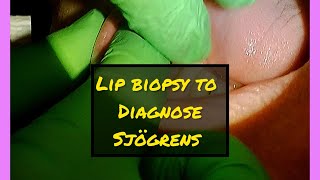 Lip Biopsy to Help Diagnose Sjögrens Disease [upl. by Rebecca]