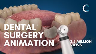 Dental Surgery Animation  Bone Grafting [upl. by Ecyar]