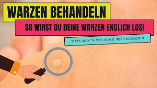 WARZEN BEHANDELN  So wirst du WARZEN endlich los [upl. by Rhu801]