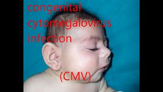 congenital cytomegalovirus infection CMV [upl. by Iraam]