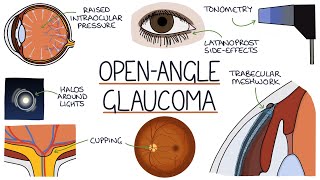 Understanding Open Angle Glaucoma [upl. by Lemuel]