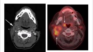 HPV and Oropharynx Cancer [upl. by Anina]