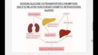 SGLT 2 Inhibitor Associated euglycemic Diabetic Ketoacidosis [upl. by Nivrek]