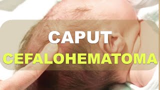 Caput Succedaneum Cefalohematoma Hemorragia Subgaleal Explicación [upl. by Cart]