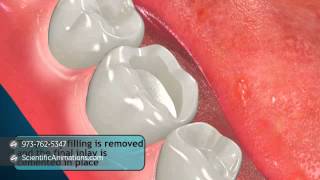 Tooth Restoration Procedures  Inlay [upl. by Waneta]