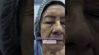 Blefaroplastia Superior antes y después cirugiaplastica [upl. by Woodsum]