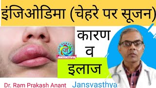 एंजिओडिमा का इलाज Treatment of Angioedema [upl. by Oker738]