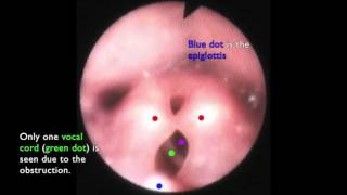 Laryngomalacia  The Floppy Airway [upl. by Ahtnammas]