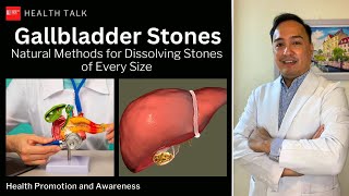 Bato sa apdo May pagasa pa bang malusaw sa natural na paraan Gallbladder stones [upl. by Margette]