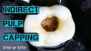 Indirect Pulp CappingStep By Step [upl. by Shepard]