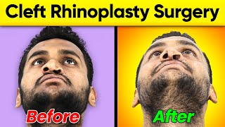 Cleft Rhinoplasty Surgery Transformation Before and After Nose Job Surgery [upl. by Ahsemrac163]