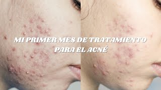 Un mes de tratamiento para el acné  primer mes con doxiciclina y epiduo gel [upl. by Auria]