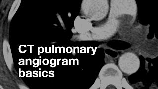 Pulmonary CT Angiogram Basics [upl. by Inilam186]