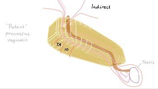 How do we get inguinal hernias [upl. by Brantley369]