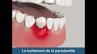 Le traitement de la Parodontite  Esthetic Hair Smile [upl. by Einej]