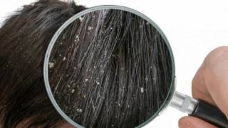 Difference Between Lice and Dandruff [upl. by Zacarias]