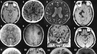 BRAIN NCC NEURO CYSTIC CERCOSIS [upl. by Ymeraj699]