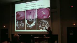 Aspect en endoscopie et échoendoscopie des tumeurs sousmuqueuses digestives  Dr L PALAZZO Paris [upl. by Ludba642]