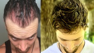 How I Quit The World’s Best Hair Loss Treatment and Regrew My Hair Naturally  Connor Murphy [upl. by Ynnhoj76]