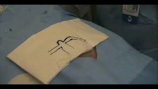 Infraclavicular Subclavian Placement [upl. by Anaed]