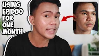 EPIDUO REVIEW  ACNE TREATMENT  1 MONTH USING EPIDUO  ADAPALENE  BENZOYL PEROXIDE [upl. by Yrdua]