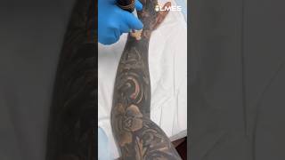 How to remove a Permanent Tattoo Laser vs Tattoo ☠️ [upl. by Bullion]