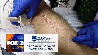 How The New VenaSeal Varicose Vein Treatment Works  SLUCare Health Watch [upl. by Ongun]