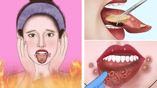 ASMR Canker sores cause of mouth ulcer treatment  Tonsil stone removal animation [upl. by Atikel]