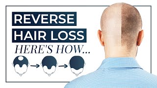 How To Reverse Hair Loss  Treatment DHT Blocking Shampoo Medication [upl. by Pittel]