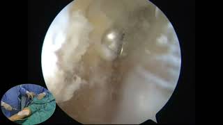 Arthroscopic Debridement Facetectomy and Synovectomy for Isolated Patellofemoral Osteoarthritis [upl. by Jonell]