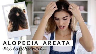 STORYTIME TENGO ALOPECIA AREATA  karelytips [upl. by Diley]